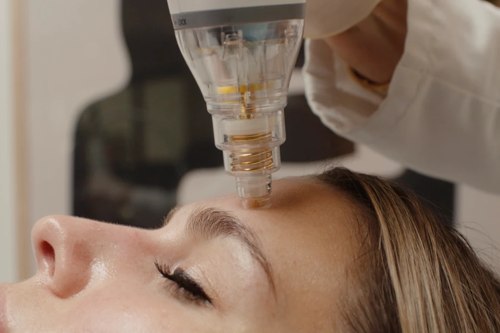 Traitement Potenza avec microneedling et radiofréquence combiné aux exosomes.