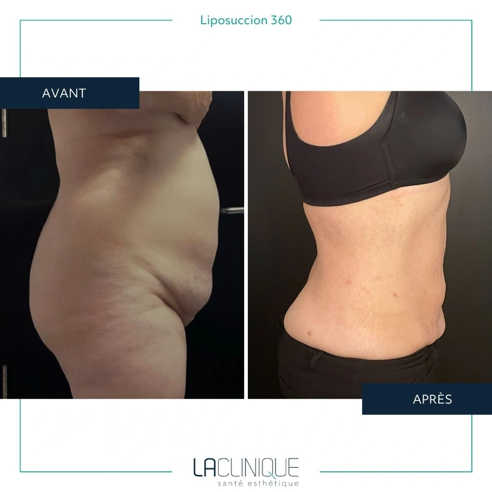 Avant après liposuccion du flanc, transformation de la silhouette, à la Clinique Santé Esthétique