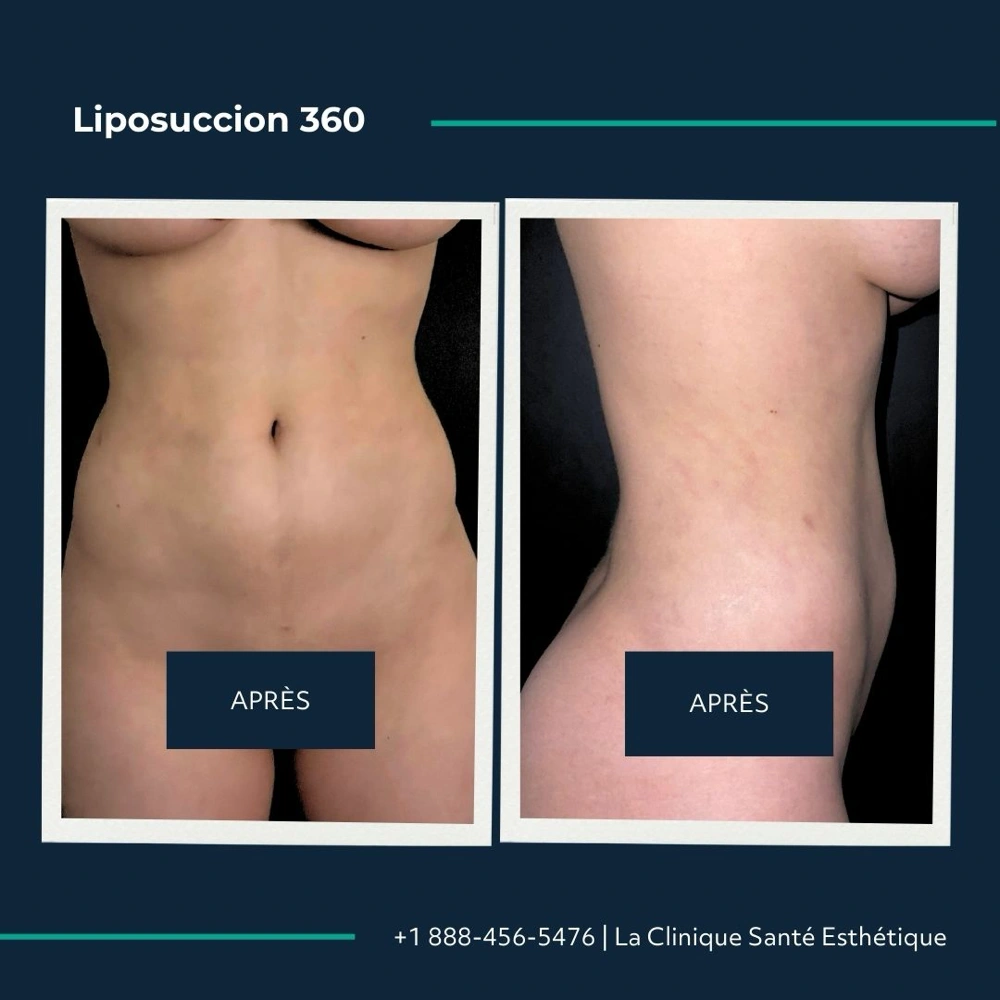 Avant après liposuccion du flanc, profil avec taille redessinée, à la Clinique Santé Esthétique