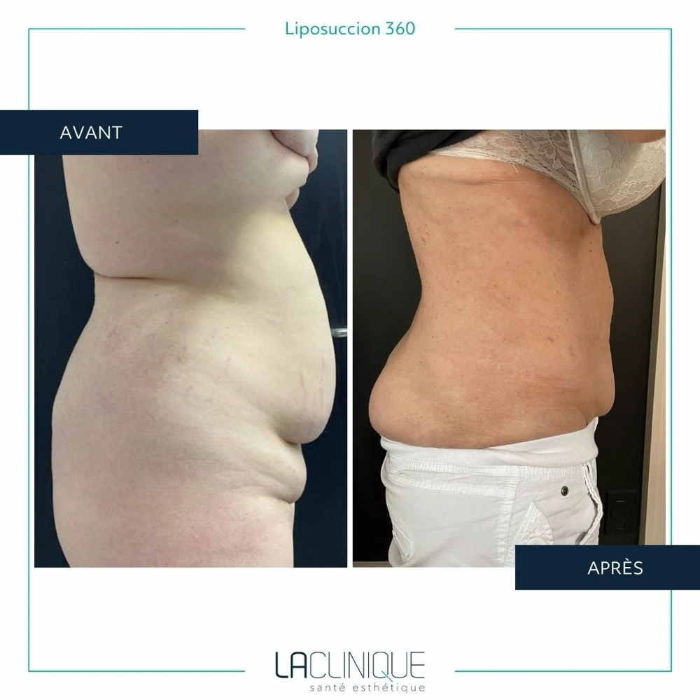 Avant après liposuccion du flanc, vue du dos, à la Clinique Santé Esthétique