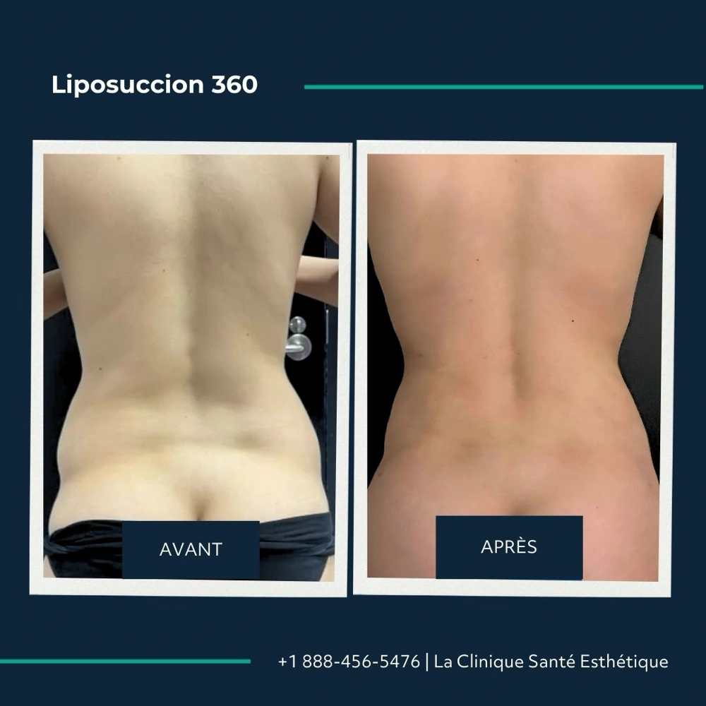 Avant après liposuccion du flanc, vue frontale de l’abdomen, à la Clinique Santé Esthétique