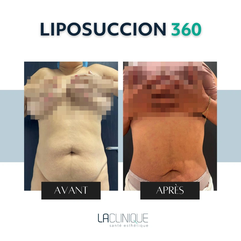 Avant après liposuccion 360, profil de la taille et des hanches, à la Clinique Santé Esthétique
