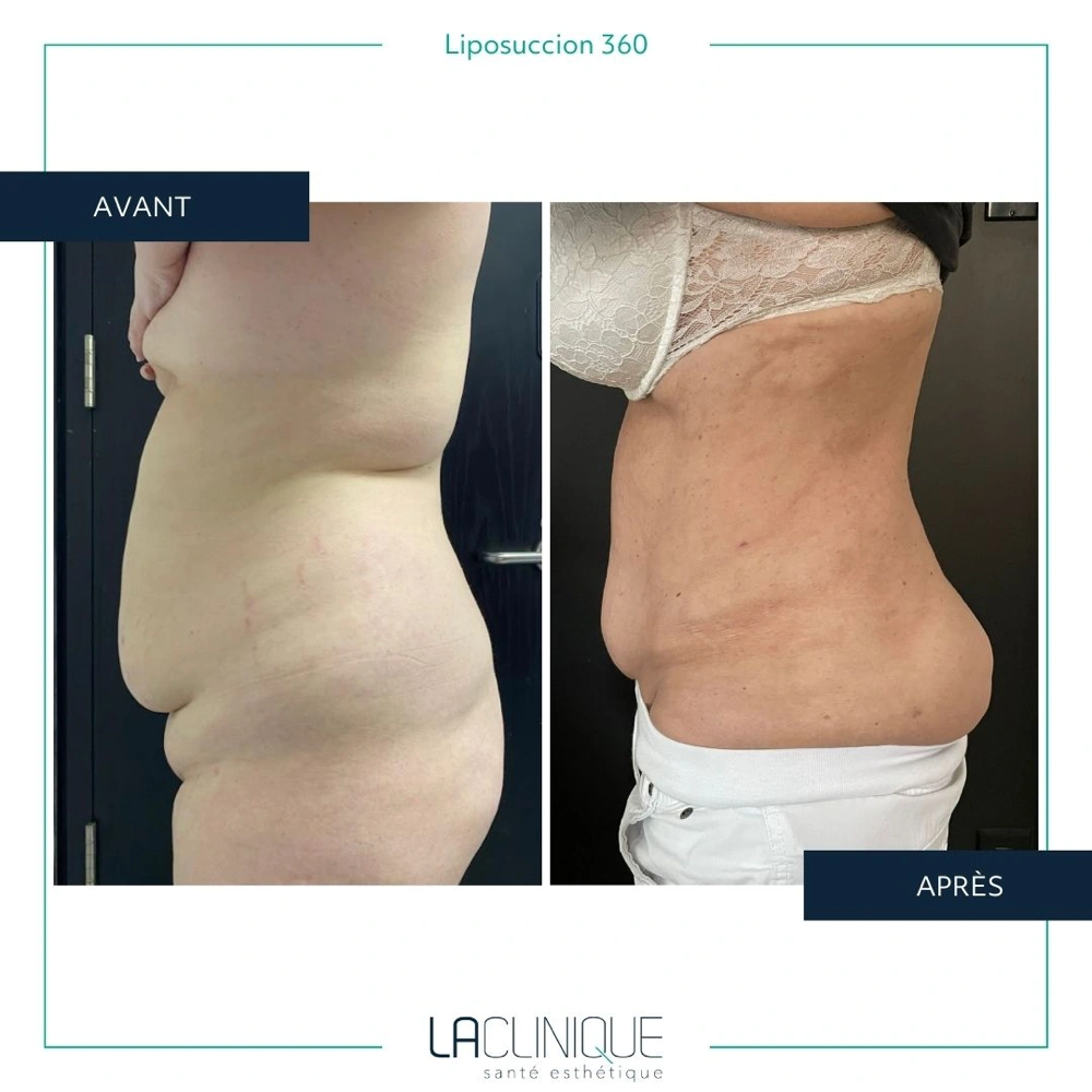 Avant après liposuccion du flanc, autre vue de profil, à la Clinique Santé Esthétique