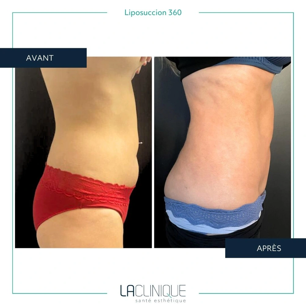 Avant après liposuccion du flanc, profil taille et hanche, à la Clinique Santé Esthétique