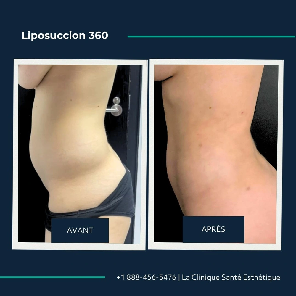 Avant après liposuccion du flanc, profil abdominal, à la Clinique Santé Esthétique