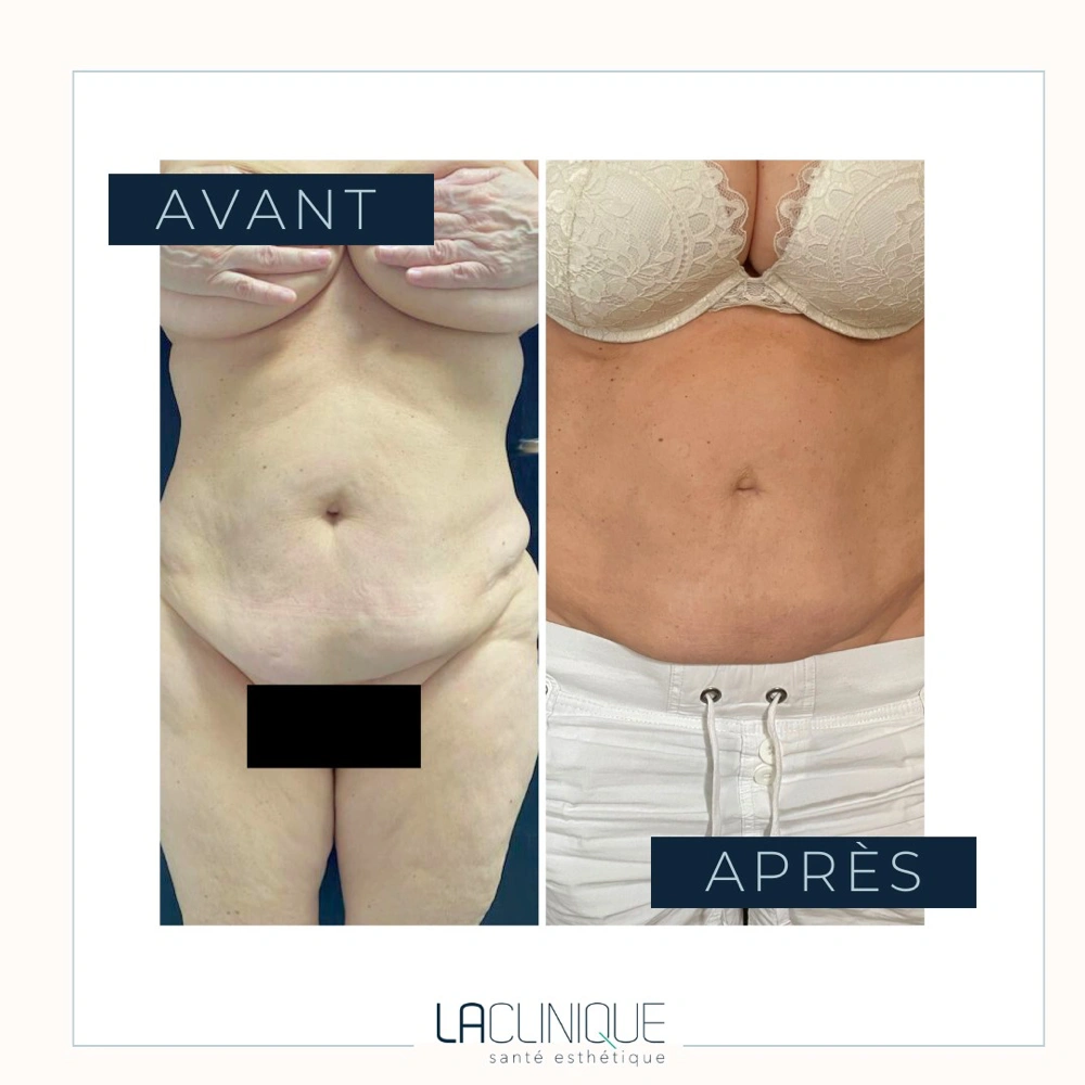 Avant après liposuccion 360, vue du dos, à la Clinique Santé Esthétique