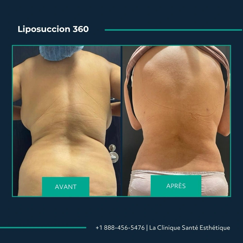 Avant après liposuccion du flanc, dos et hanches, à la Clinique Santé Esthétique