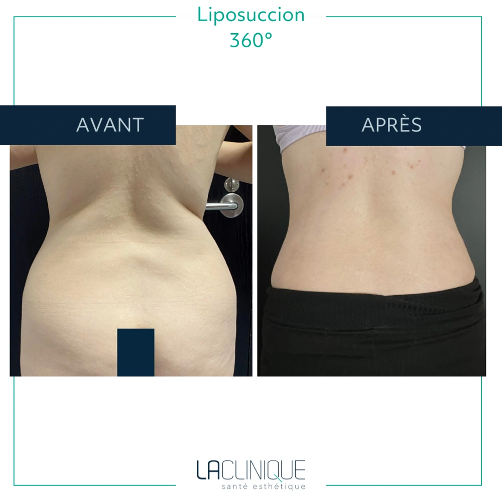 Avant après liposuccion du flanc, résultat sur la taille et le ventre, à la Clinique Santé Esthétique