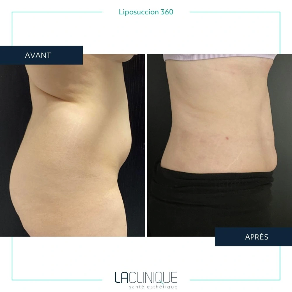 Avant après liposuccion du flanc, profil de la taille, à la Clinique Santé Esthétique