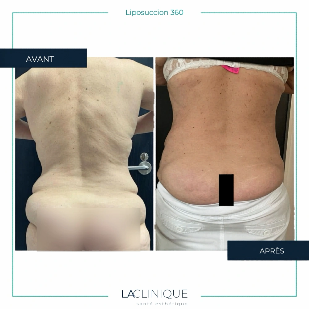 Avant après liposuccion 360, silhouette de profil, à la Clinique Santé Esthétique