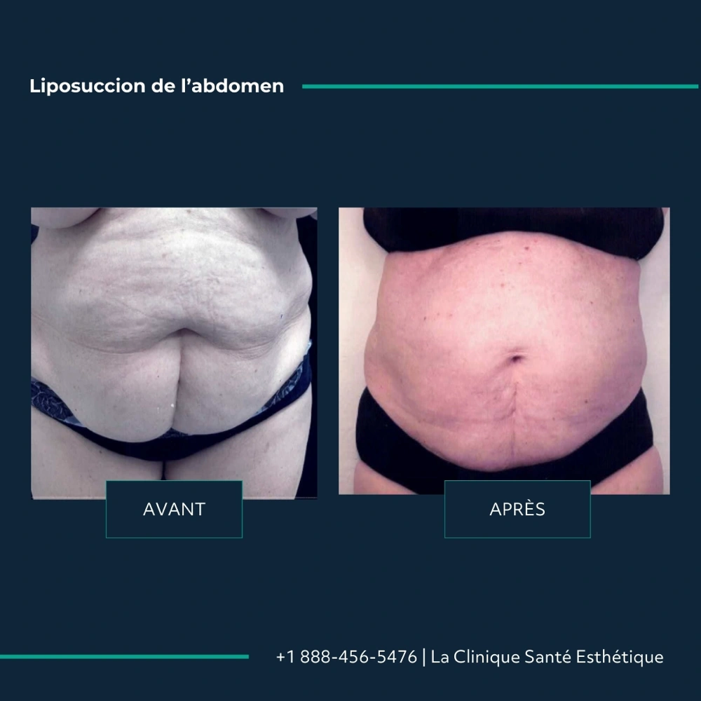 Avant après liposuccion de l’abdomen, vue de face, à la Clinique Santé Esthétique