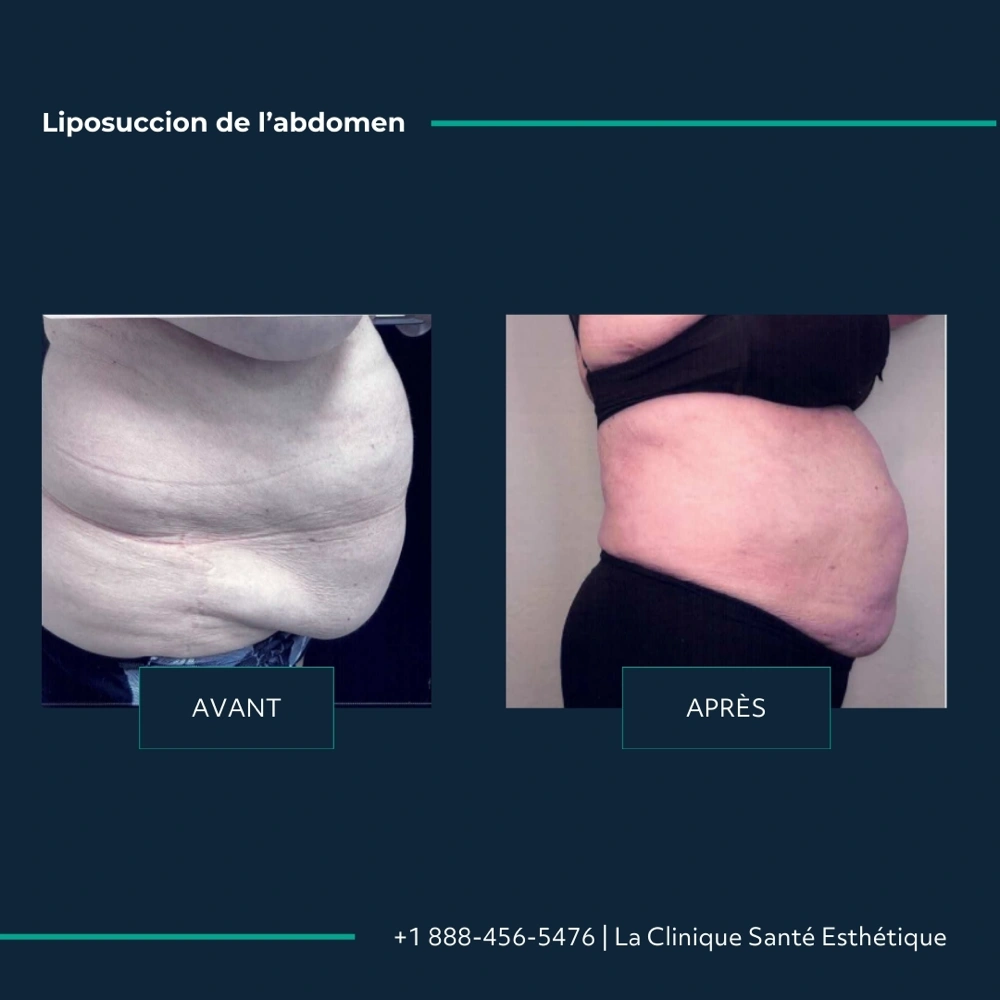 Avant après liposuccion de l’abdomen, vue de profil droit, à la Clinique Santé Esthétique