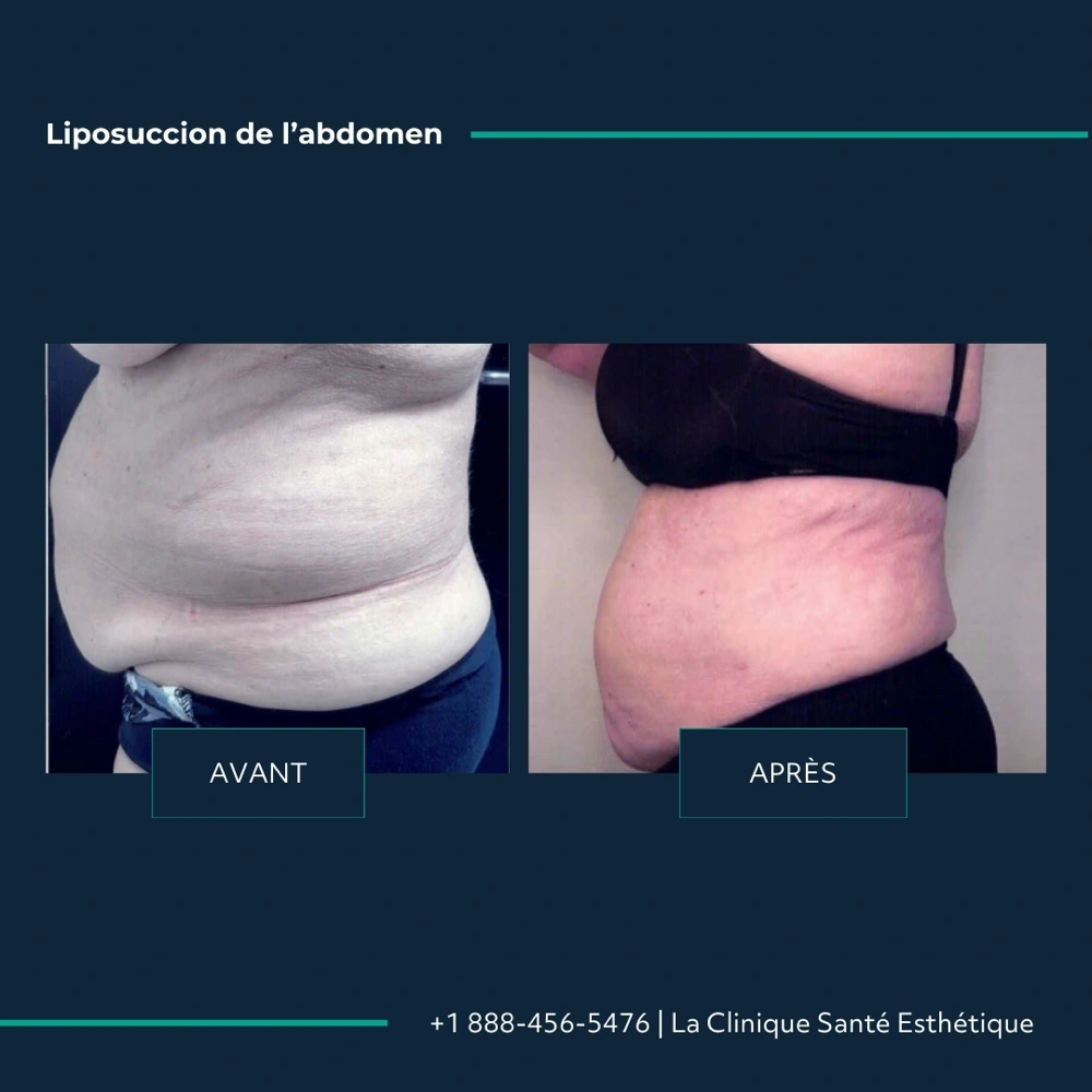 Avant après liposuccion de l’abdomen, vue de profil gauche, à la Clinique Santé Esthétique