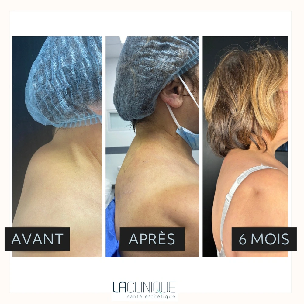 Avant après liposuccion de la bosse de bison, profil du haut du dos, à la Clinique Santé Esthétique