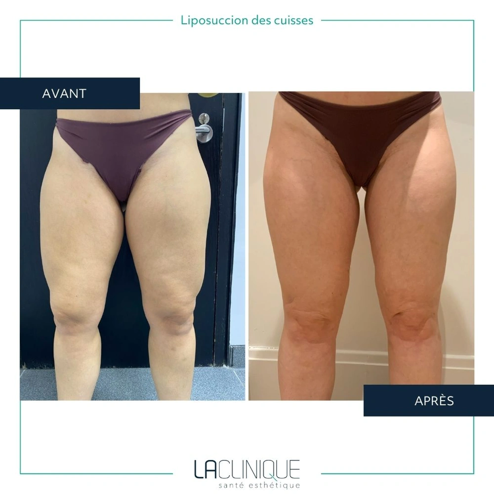 Avant après liposuccion des cuisses, vue arrière, à la Clinique Santé Esthétique