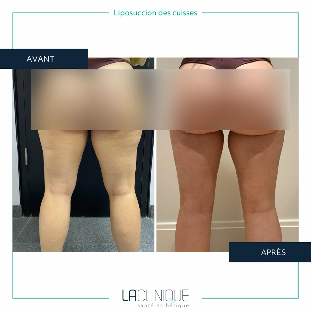 Avant après liposuccion des cuisses, vue de face, à la Clinique Santé Esthétique