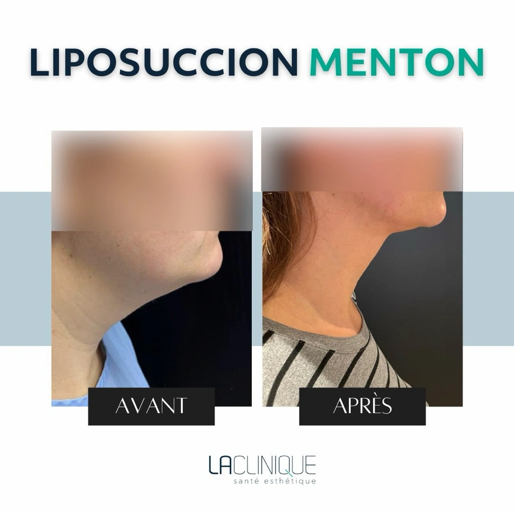 Avant après liposuccion du menton, autre profil avant après, à la Clinique Santé Esthétique