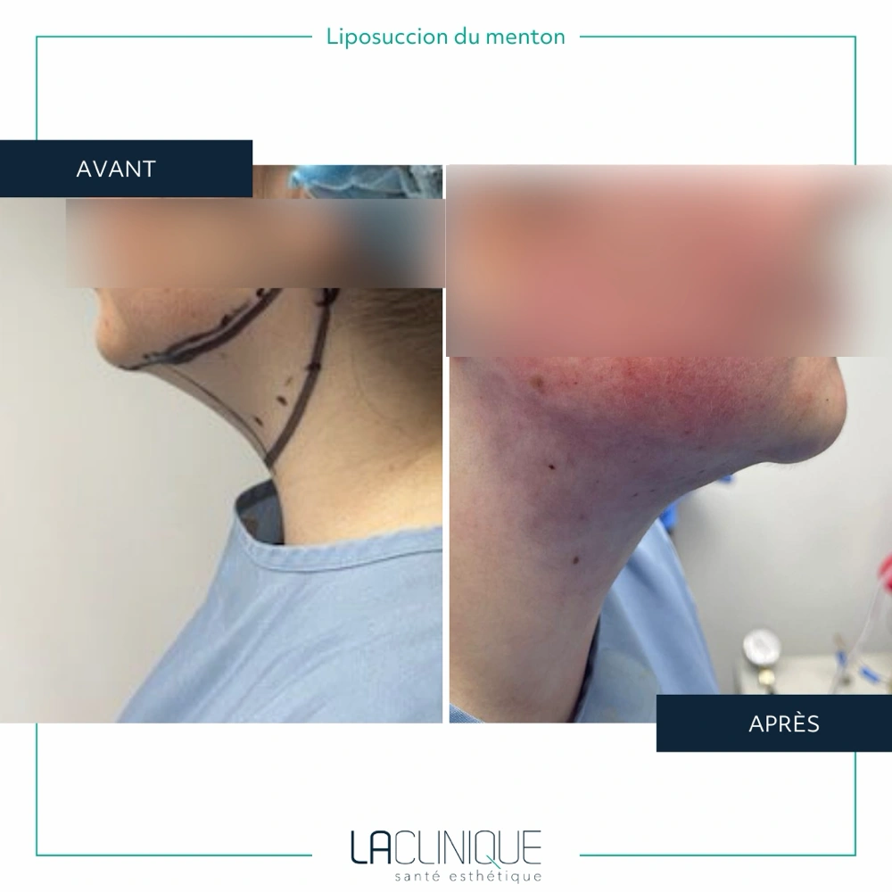 Avant après liposuccion du menton, profil du cou et de la mâchoire, à la Clinique Santé Esthétique