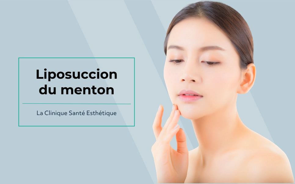 Patiente illustrant la liposuccion du menton pour affiner le contour du visage et réduire l’apparence du double menton.